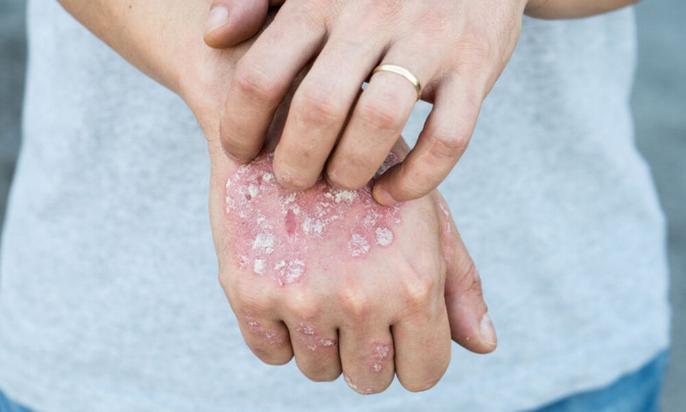 Έκζεμα ή κάτι άλλο; 4 σημεία που πρέπει να προσέξετε (εικόνες)