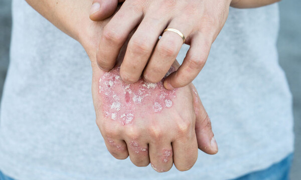 Έκζεμα ή κάτι άλλο; 4 σημεία που πρέπει να προσέξετε (εικόνες)