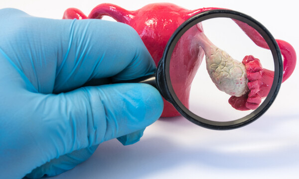 Σύνδρομο πολυκυστικών ωοθηκών: Για ποιες χρόνιες παθήσεις αυξάνει τον κίνδυνο (εικόνες)