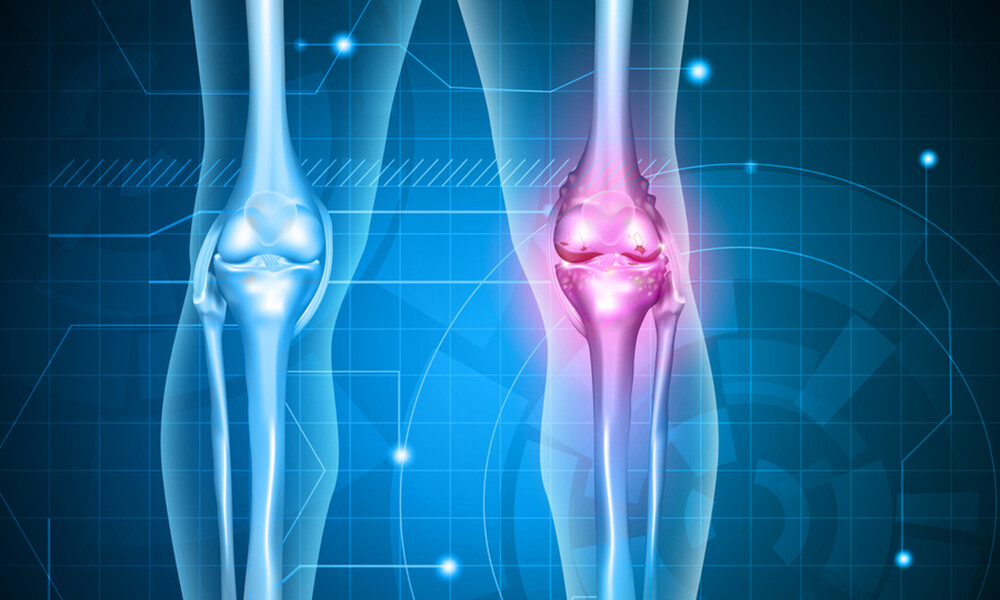 Οστεοαρθρίτιδα: 6 φυσικές θεραπείες που πρέπει να γνωρίζετε (εικόνες)