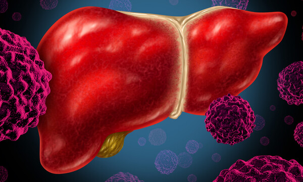 Κίρρωση του ήπατος: 6 ενδείξεις που πρέπει να προσέξετε (video)