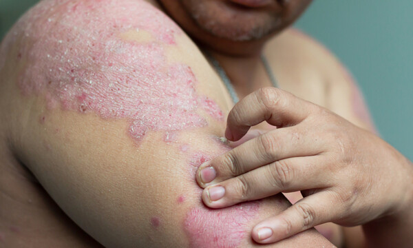 Μήπως έχετε ψωρίαση; Δείτε τα «ύποπτα» συμπτώματα σε εικόνες