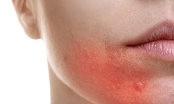 Οι «καλές» συνήθειες που πυροδοτούν την ακμή (εικόνες)