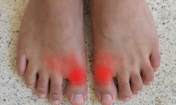 Ουρική αρθρίτιδα: Ποιοι κινδυνεύουν από τη φλεγμονώδη νόσο των αρθρώσεων (εικόνες)