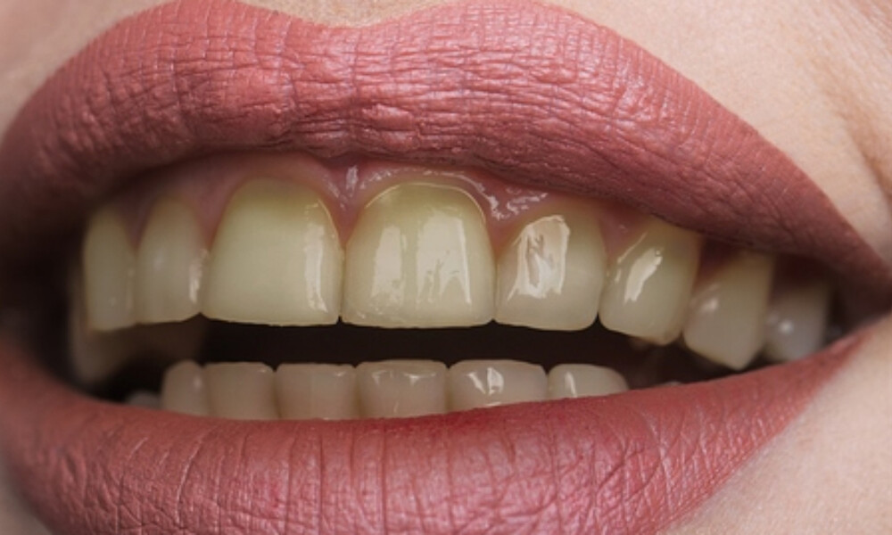 Δόντια που κιτρινίζουν: Οι τροφές που πρέπει να αποφεύγετε (εικόνες)