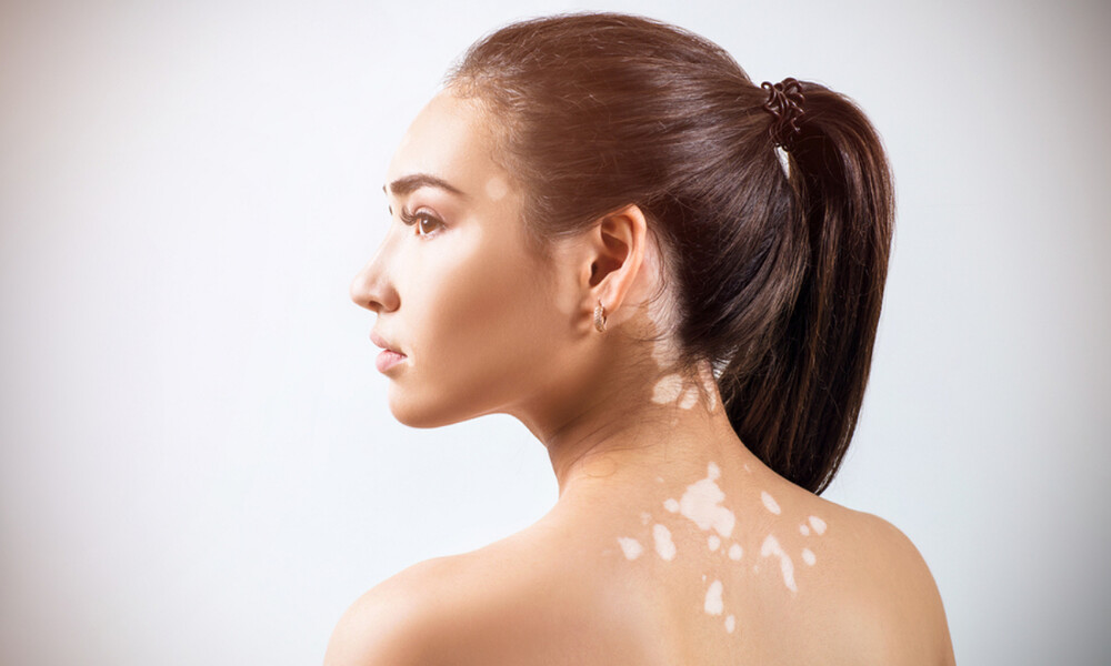 Λεύκη: Γνωρίστε τη δερματική πάθηση μέσα από φωτογραφίες