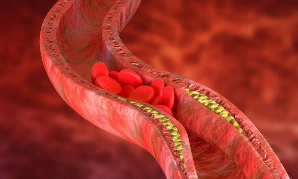 Σημάδια που δείχνουν σοβαρό πρόβλημα στις αρτηρίες (εικόνες)
