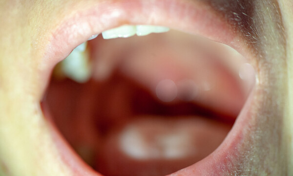 Στοματικά έλκη: Πώς θα τα αντιμετωπίσετε (εικόνες)