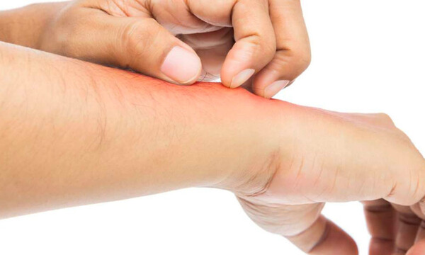 Δερματίτιδα από σαπούνι: Προσοχή σε αυτά τα αλλεργιογόνα (εικόνες)