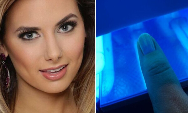 Αισθητικός πρόσεξε μια μελανιά στο νύχι πελάτισσας! Η άμεση επέμβαση των γιατρών ήταν σωτήρια...