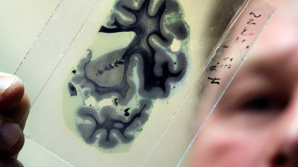 Υγιεινές καθημερινές συνήθειες μειώνουν τον κίνδυνο εμφάνισης Αλτσχάιμερ 