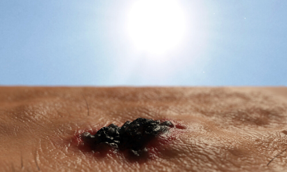 Καρκίνος δέρματος: Τα προειδοποιητικά σημάδια μέσα από φωτογραφίες