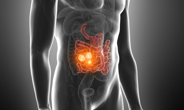 Ορθοκολικός καρκίνος: Οι παράγοντες που αυξάνουν τον κίνδυνο (εικόνες)