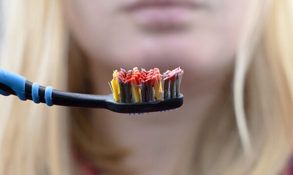 Περιοδοντική νόσος: Για ποιους καρκίνους αυξάνει τον κίνδυνο