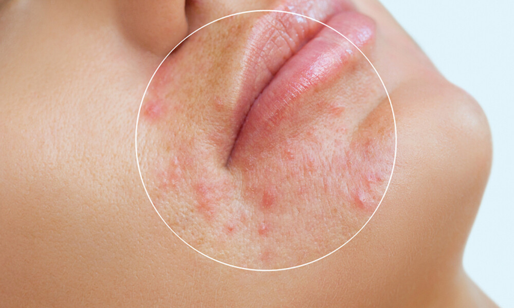 Ακμή: Οι κανόνες διατροφής που πρέπει να τηρείτε ευλαβικά (εικόνες)