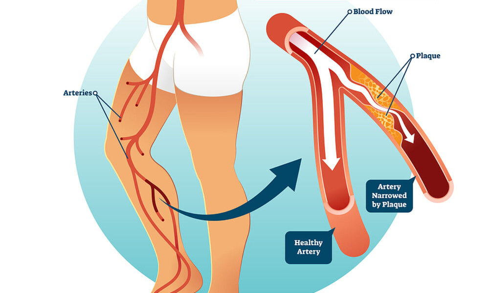 Περιφερική αρτηριοπάθεια: Τι είναι και ποιοι κινδυνεύουν περισσότερο (εικόνες)