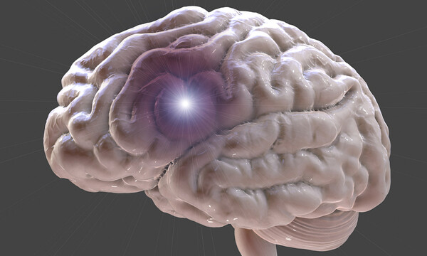 Ανεύρυσμα εγκεφάλου: Με ποια συμπτώματα εκδηλώνεται (εικόνες)