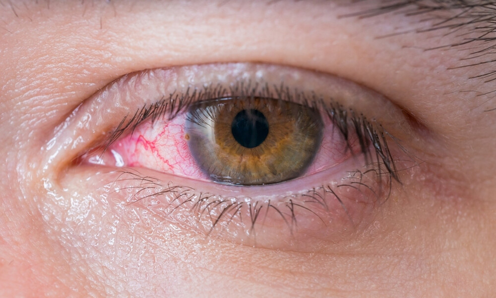 Κοκκίνισμα ματιών: 9 αιτίες & τι μπορείτε να κάνετε (φωτο)