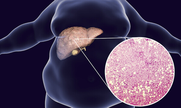 Λίπος στο συκώτι: Με ποιες τροφές θα το μειώσετε (εικόνες)
