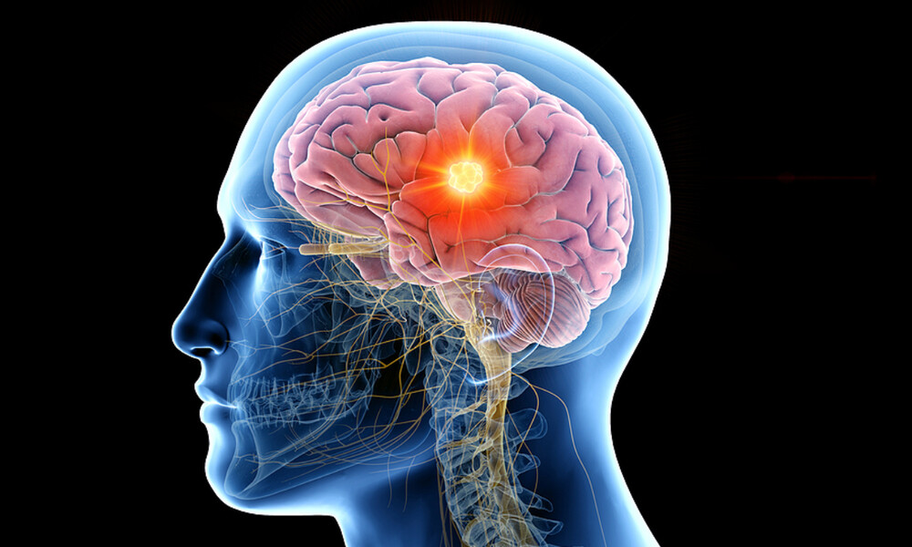 Όγκος στον εγκέφαλο: 7 προειδοποιητικά σημάδια που πρέπει να ξέρετε (βίντεο)