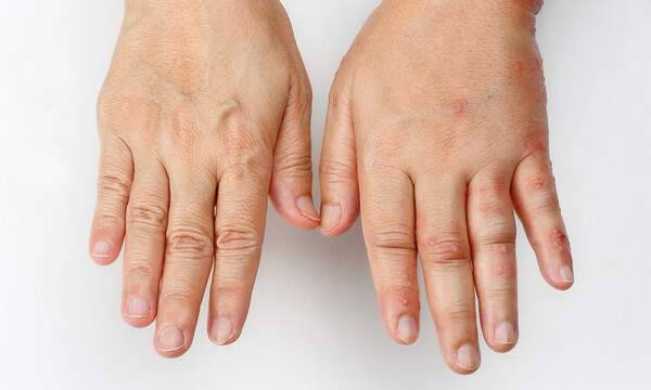 Πρήξιμο: Πότε είναι ανησυχητικό (βίντεο)