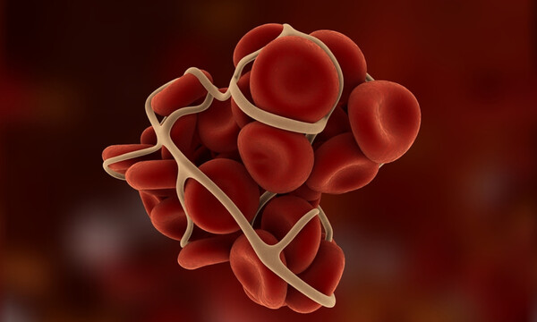 Θρόμβος στο πόδι: 5 τροφές που τον προλαμβάνουν (εικόνες)