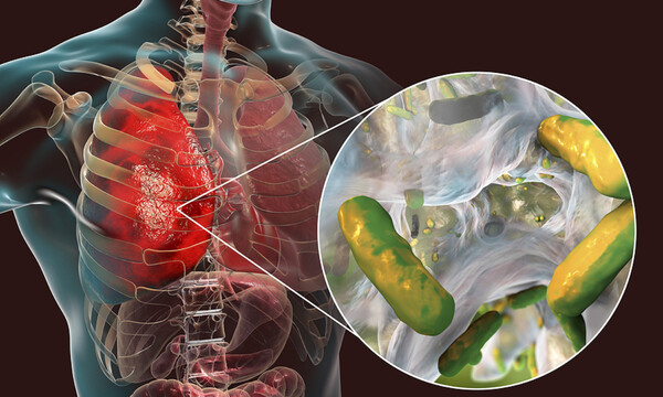 Ψευδομονάδα: Τα συμπτώματα της λοίμωξης από το ανθεκτικό μικρόβιο (photos)