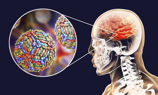 Εγκεφαλίτιδα: 6 ενδείξεις σε εικόνες