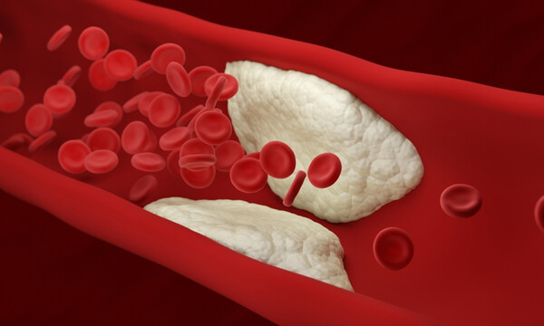 Φραγμένες αρτηρίες: Αυτές είναι οι 12 απαγορευμένες τροφές (εικόνες)