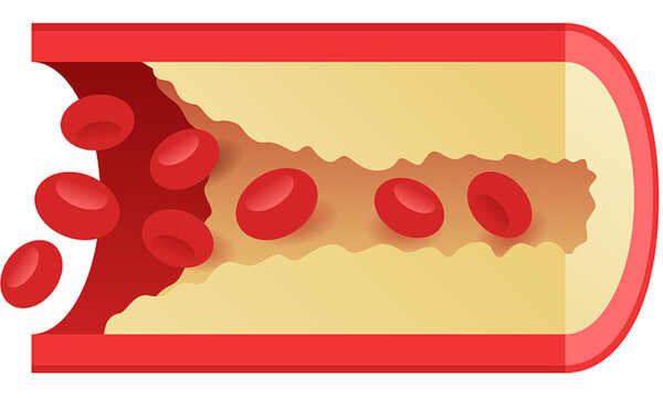 Στεφανιαία νόσος: Τα προειδοποιητικά συμπτώματα που πρέπει να γνωρίζετε (εικόνες)