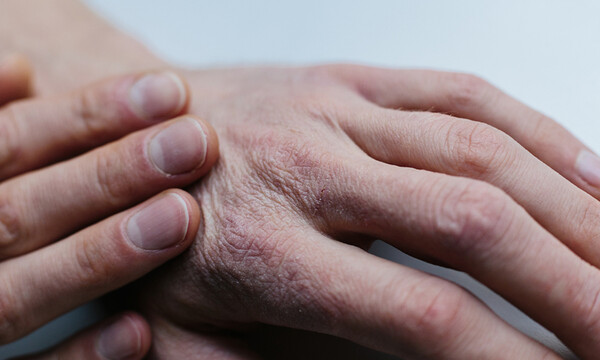Ξηροδερμία: Με ποια προβλήματα υγείας συνδέεται (photos)