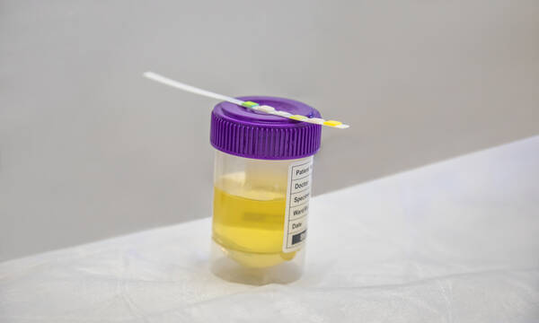 Ούρα: Ποια προβλήματα υγείας επηρεάζουν το χρώμα τους (εικόνες)