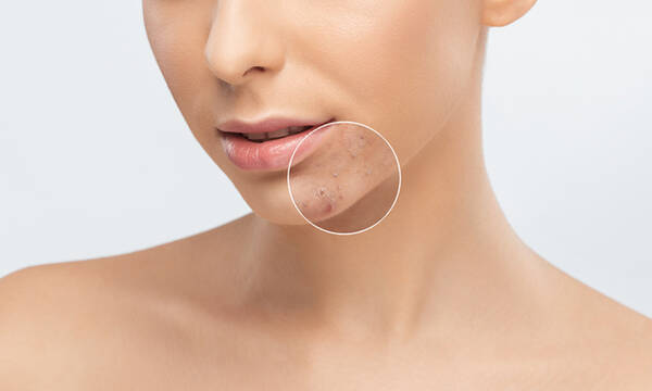 Ακμή και καλοκαίρι: Τι πρέπει να γνωρίζετε (εικόνες)