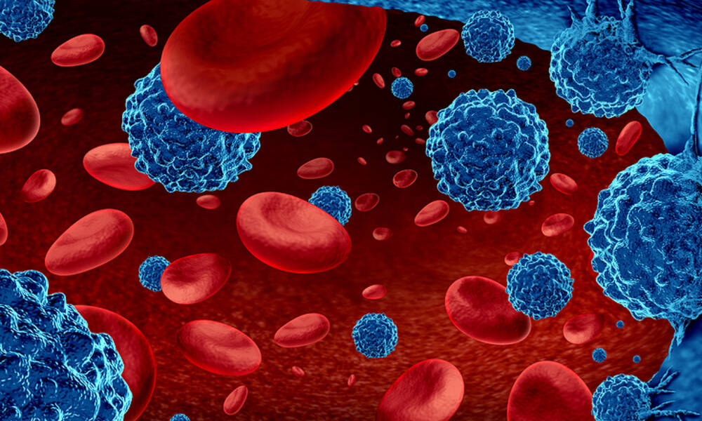 Λέμφωμα: Τα ύποπτα συμπτώματα που πρέπει να γνωρίζετε (εικόνες)