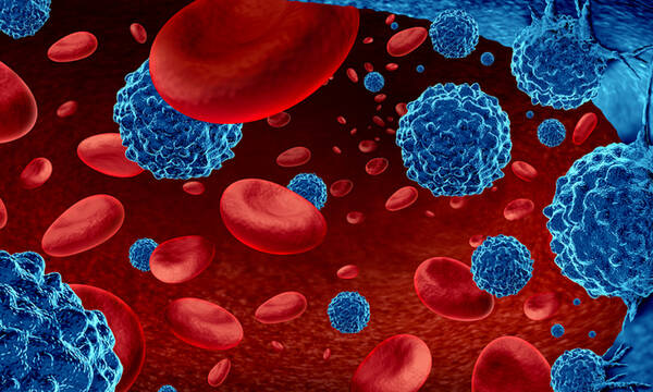 Λέμφωμα: Τα ύποπτα συμπτώματα που πρέπει να γνωρίζετε (εικόνες)