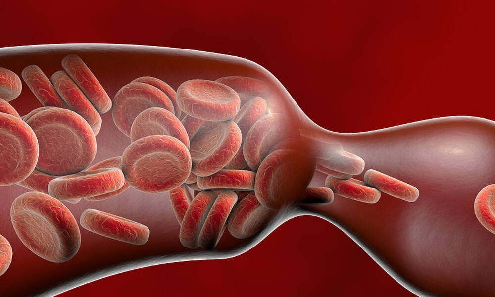 Θρόμβωση: Για ποιες αιτίες καρδιαγγειακού θανάτου ευθύνεται (εικόνες)