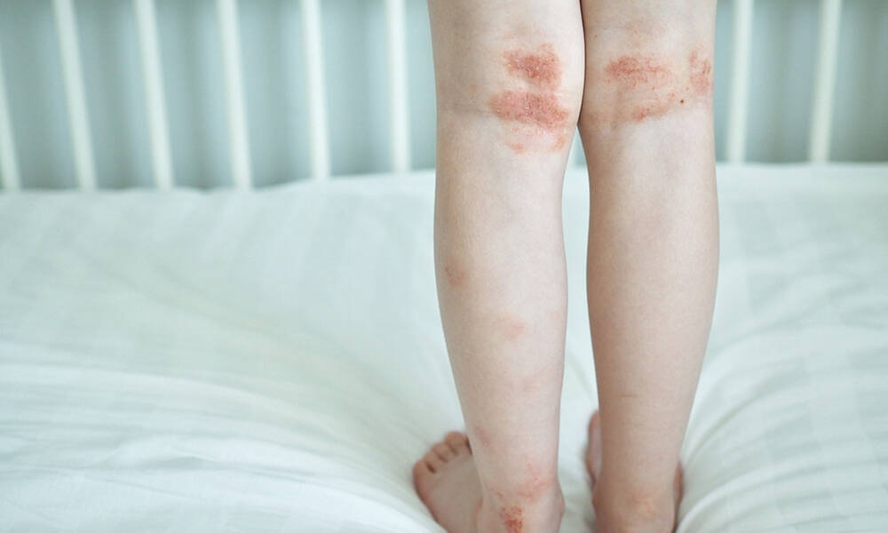 Παγκόσμια Ημέρα Ατοπικής Δερματίτιδας: Η βιταμίνη που ανακουφίζει από τα συμπτώματα (εικόνες)