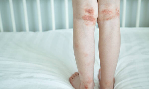 Παγκόσμια Ημέρα Ατοπικής Δερματίτιδας: Η βιταμίνη που ανακουφίζει από τα συμπτώματα (εικόνες)