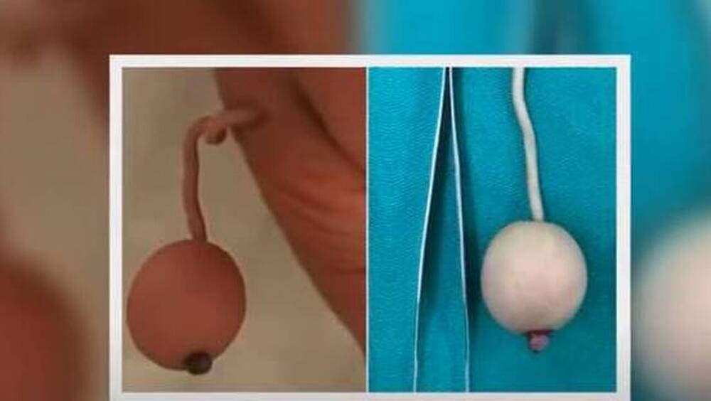 Βραζιλία: Μωράκι γεννήθηκε με ουρά 12 εκατοστών - Πώς το εξηγούν οι επιστήμονες