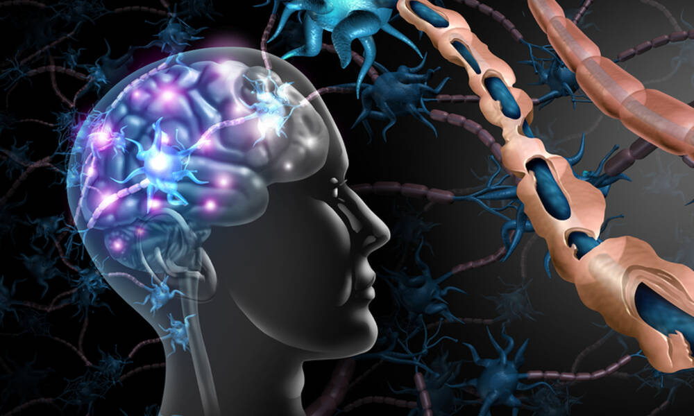 Σκλήρυνση κατά πλάκας: Οι παράγοντες που αυξάνουν τον κίνδυνο (εικόνες)