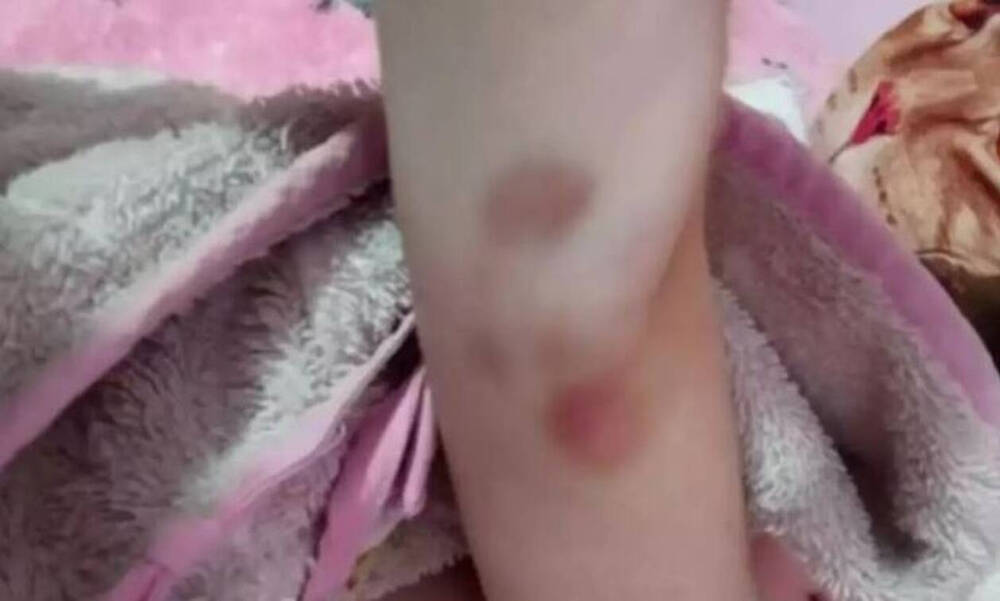 Θάνατος παιδιών στην Πάτρα: Φωτογραφία - ντοκουμέντο με μελανιές στο χέρι της Τζωρτζίνας