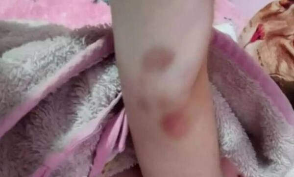 Θάνατος παιδιών στην Πάτρα: Φωτογραφία - ντοκουμέντο με μελανιές στο χέρι της Τζωρτζίνας