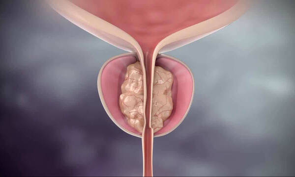 Φυσική μέθοδος Rezum για την υπερπλασία προστάτη  