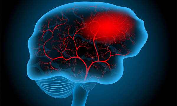 Εγκεφαλικό: Οι παράγοντες που αυξάνουν τον κίνδυνο 