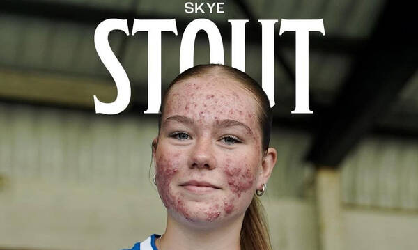 Απανθρωπιά: Bullying σε 16χρονη αθλήτρια για την εμφάνισή της